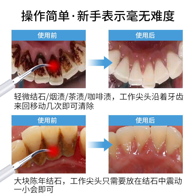 洗牙仪超声波牙结石去除器洁牙器牙渍神器