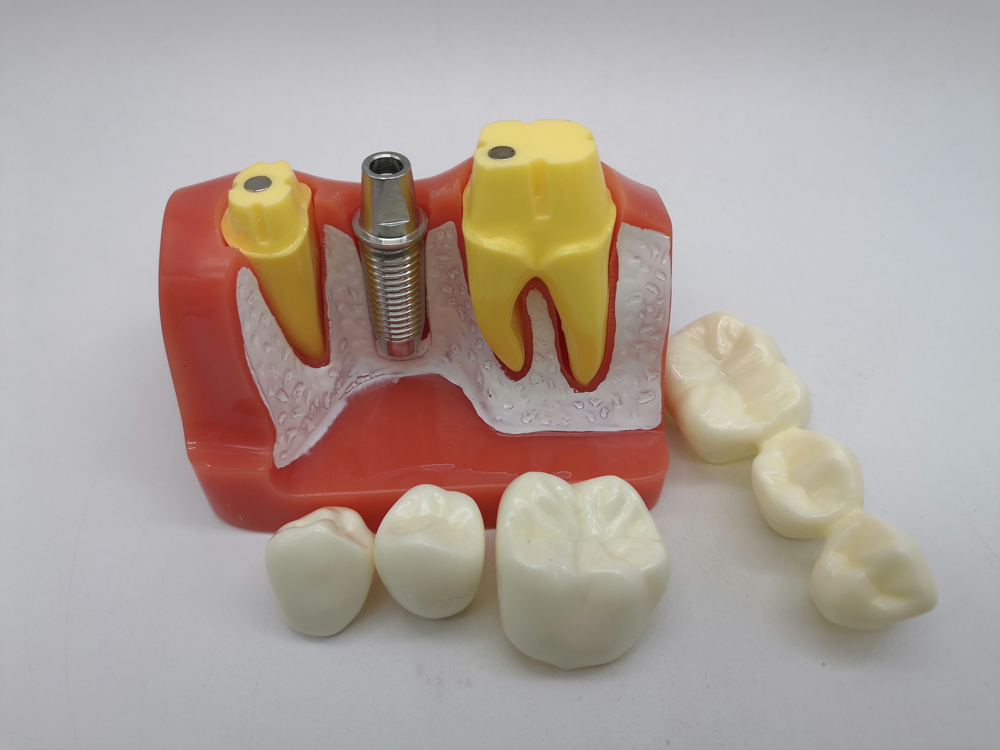 种植植体模型牙科齿科材料分解口腔教学4倍其它口腔护理设备