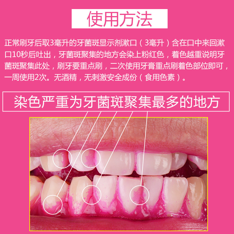 日本进口松风牙菌斑显示剂去除牙菌斑牙膏 牙结石正畸漱口水69ml