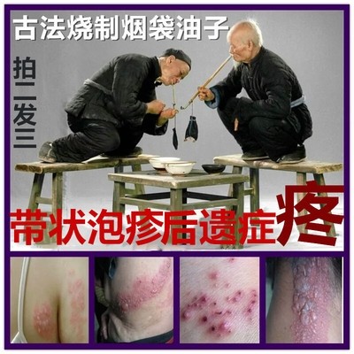 老袋油子治蛇盘疮蛇胆疮火丹蛇缠腰龙飞蛇病后遗症刺痛串疮