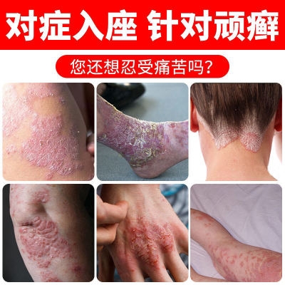 顽达康老顽固草本乳膏湿疹皮炎皮肤瘙痒礼品盒