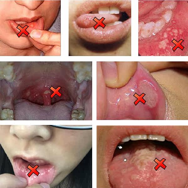 进口速效口腔溃炀复发性发发炎有效喷剂去除其它