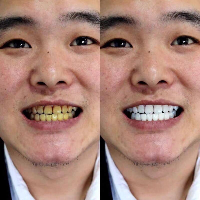 抖音烟渍清洁变白黄牙洁白氟斑去黄洗牙速效牙齿美白脱色剂