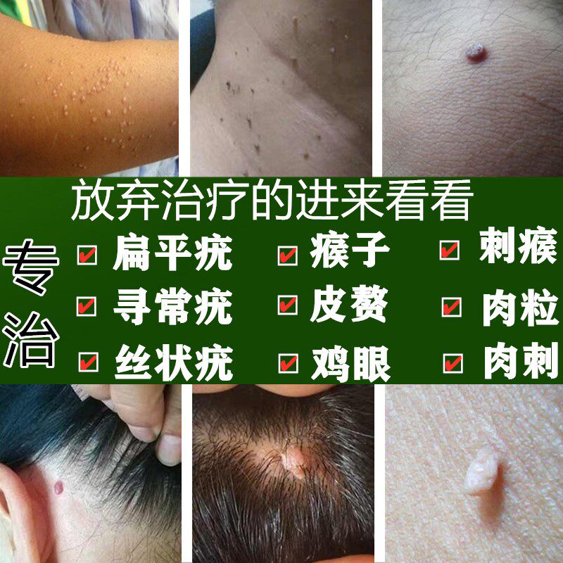肉粒跖疣膏去猴子去疣疙瘩瘊子肉刺神器去除医疗用品