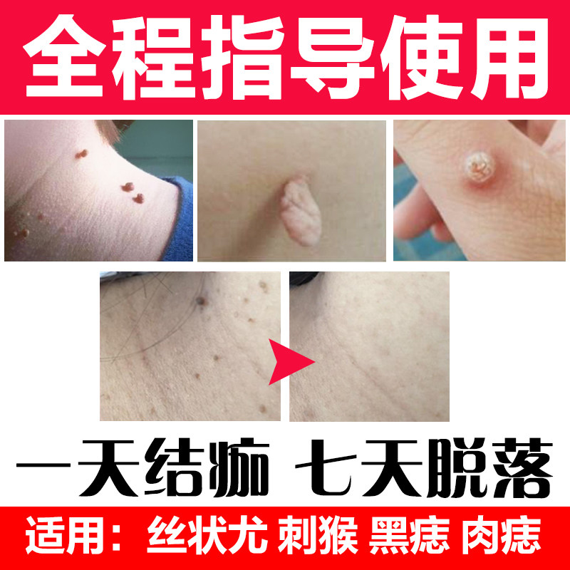 咪喹疣必肉粒颈部疣皮丝状脖子莫正旗舰软膏身体磨砂膏
