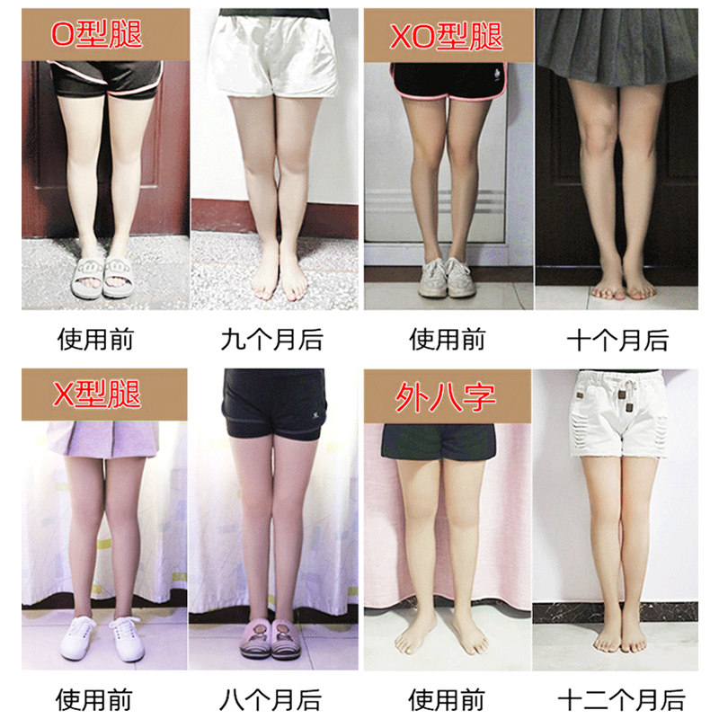 罗圈直腿成人腿形纠正xo型腿0x腿型腿部矫姿用品