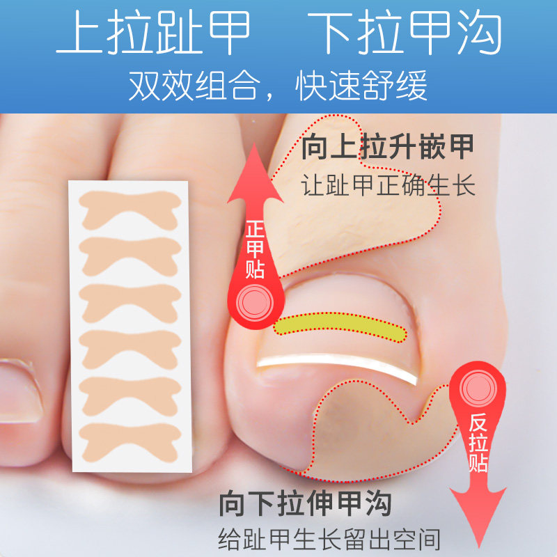 正甲贴脚趾甲甲沟嵌甲专用矫正贴片指甲长肉里美甲