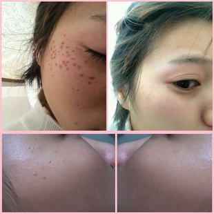 脸部祛痣黑痣斑水祛痣膏雀斑祛斑产品神器笔 点痣去