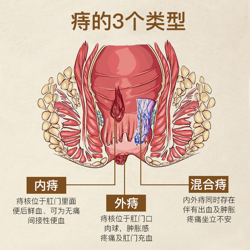 外痔图片大全图片