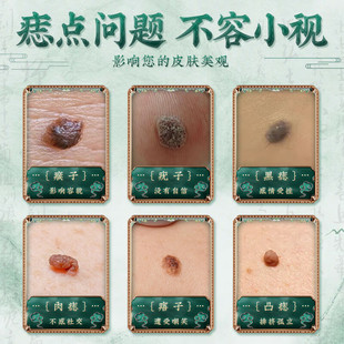 点痣膏疣候肉粒一抹无忧掉疣神器扁平疣鸡眼贴膏疣候型香港大药房