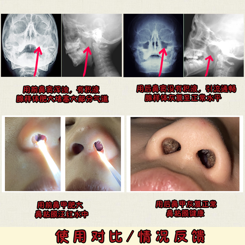 鼻窦肿大后果图片图片