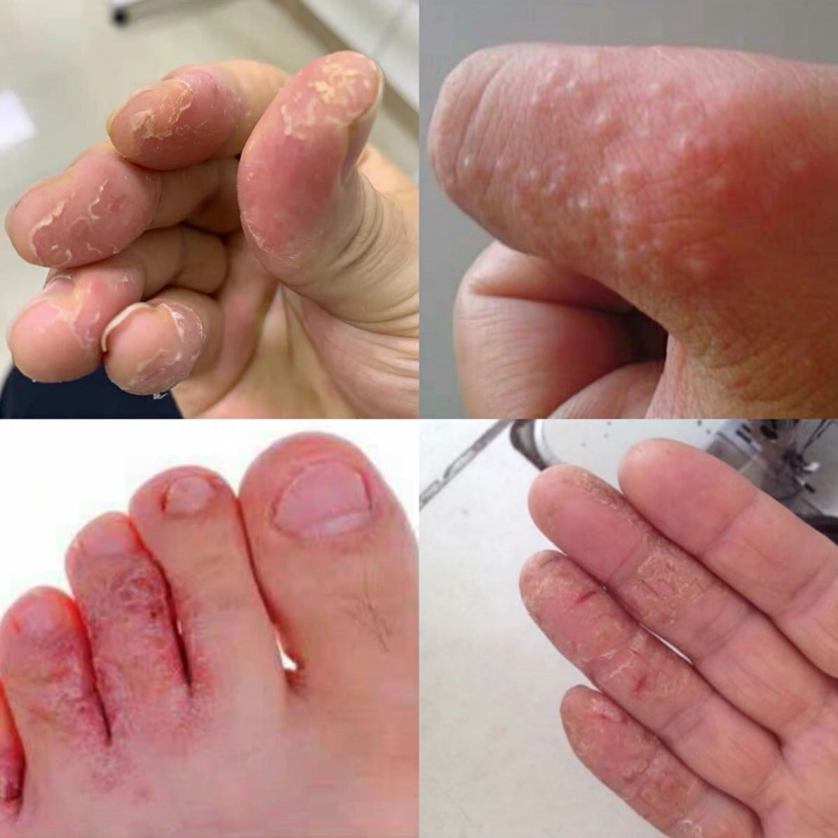 手脚脱水泡皮季节性手掌手指头蜕皮严重干裂褪起皮掉皮爆皮