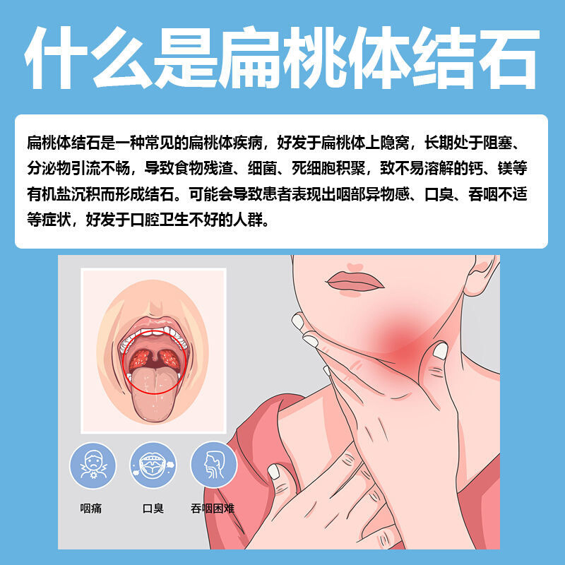 扁桃体消毒去除口臭肿痛隐窝清理口腔结石久留牙刷