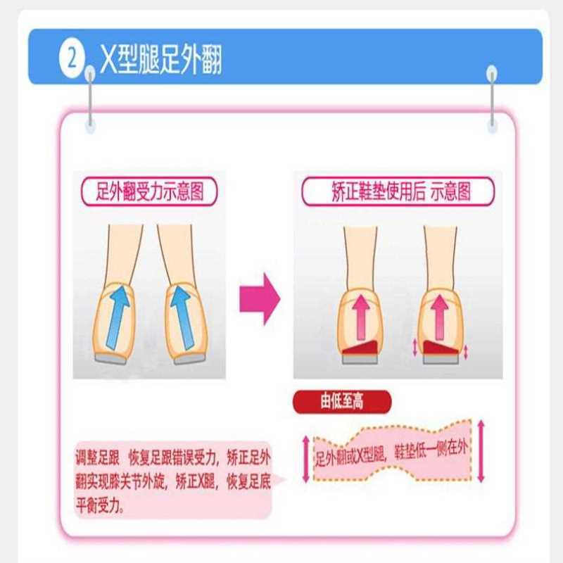 矫正腿型鞋垫xo型偏撇脚型腿小腿外翻神器纠正直腿脚跟垫鞋翻ox形