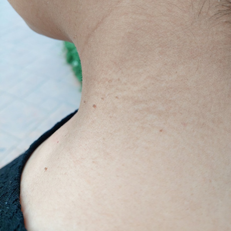 腐蚀去除脖子上的小肉粒肉球肉赘疙瘩孕妇丝状身体磨砂膏