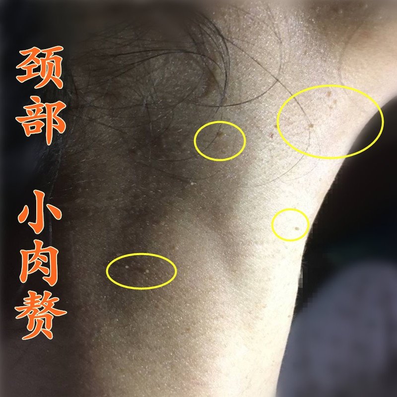 腐蚀去除脖子上的小肉粒肉球肉赘疙瘩孕妇丝状身体磨砂膏