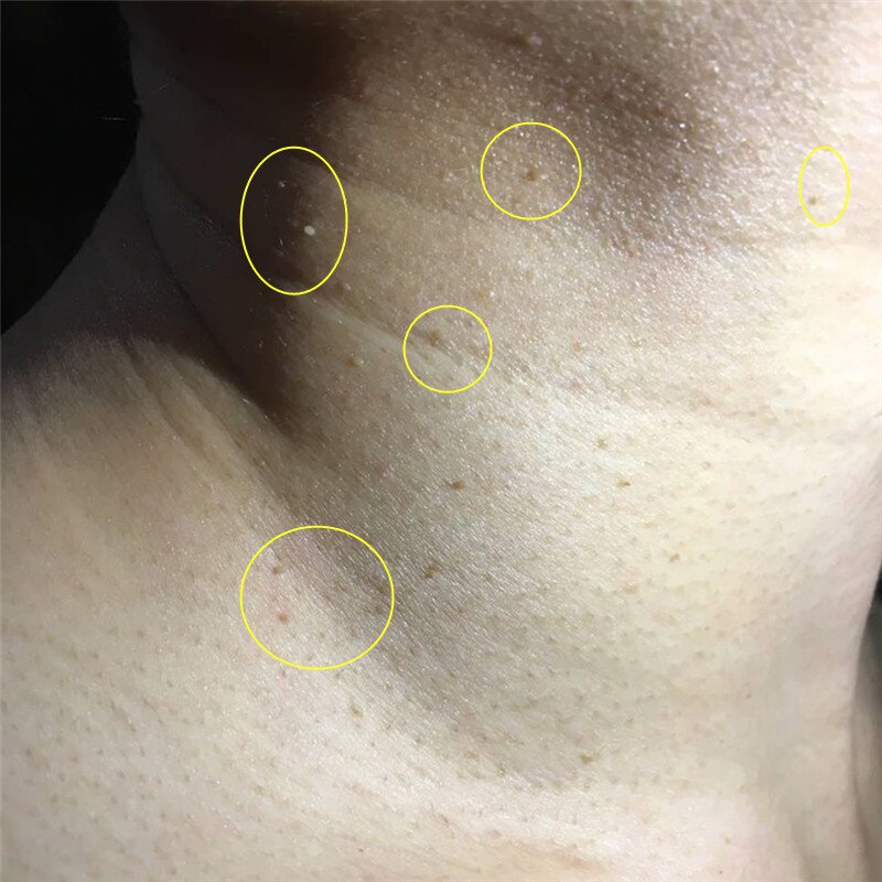 腐蚀去除脖子上的小肉粒肉球肉赘疙瘩孕妇丝状身体磨砂膏