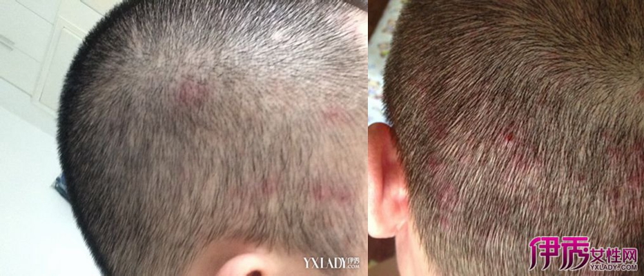 硫磺头皮皮毛囊肤炎脂溢性洗头膏去洗液痤疮洗发水