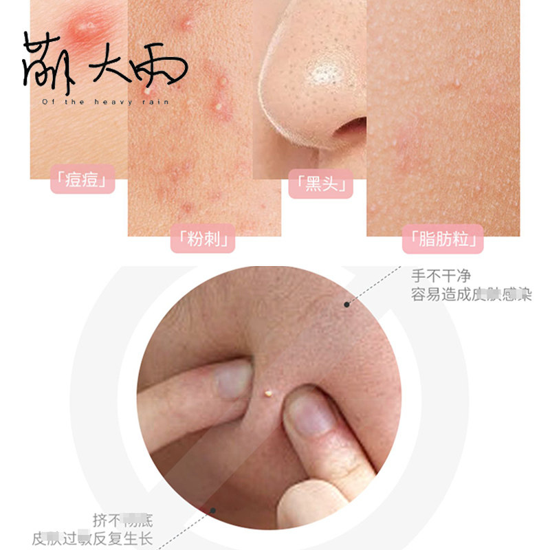 萌大雨 ukiss粉刺挑痘痘黑头祛痘暗疮清闭口粉刺针美容不锈钢套装