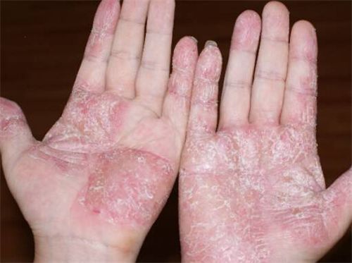 治手足癣膏手癣鹅掌风真菌感染脱皮水泡成人手足藓止痒药膏手足藓