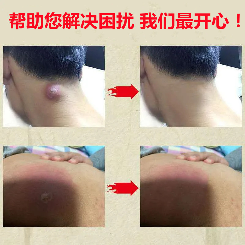 断痒拔毒膏拔脓膏成人脸部痘痘私处肛周坐板护膝
