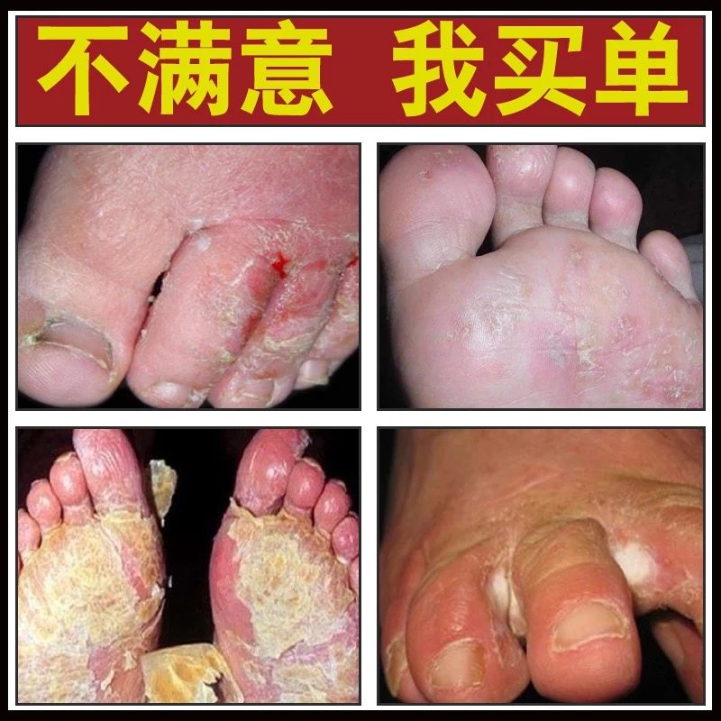 进口治脚气止痒脱皮脚汗去除脚臭脚痒水泡型烂脚丫泡脚粉特膏王