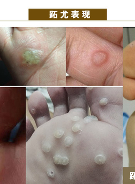 8淘宝店陕西 西安去看看陕西修脚足浴店郑远元脱甲膏红药黑药血泡刺腐