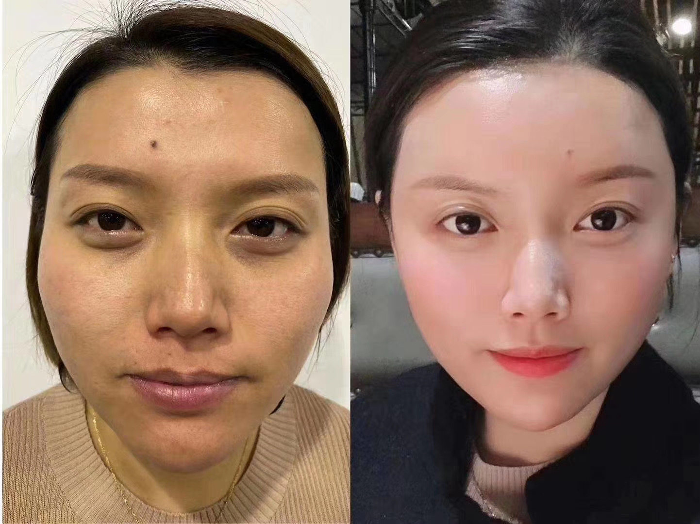 暨大深导创科加强型私密紧致饱满美容院冻干粉凹陷皱纹逆龄佰分佰