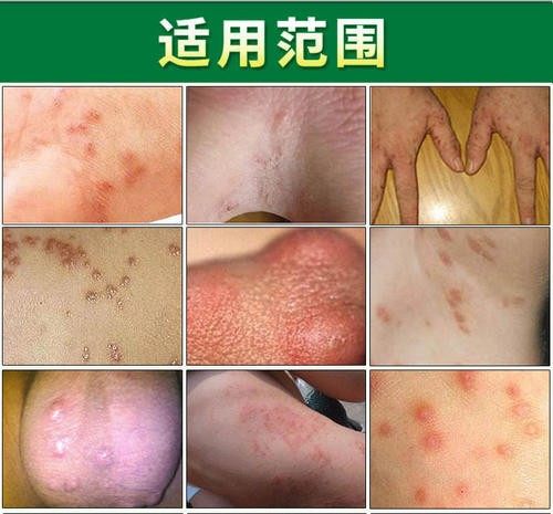 疥疮膏去根疥疮结节一扫光特效药去疥疮膏药干疮膏止痒外用疥疮药
