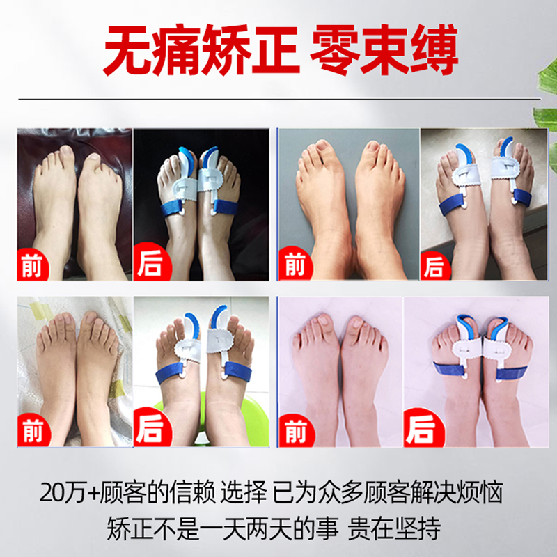 9 分享 推荐理由 柔软舒适,变形,无痛矫正,轻薄透气,日夜可用,告别