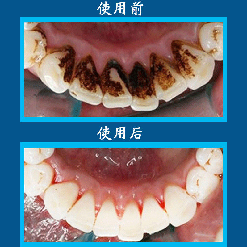 牙结石去除器工具牙垢牙齿清洁家用剔刮清除牙石洗牙洁牙牙渍神器