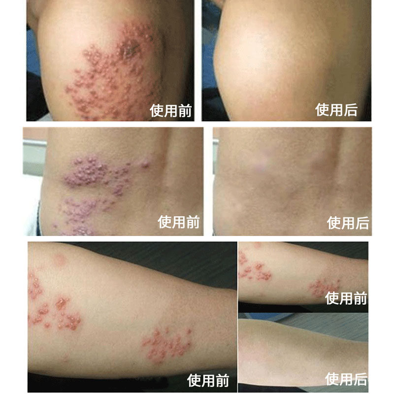 蛇盘疮后遗症 蛇胆疮蛇盘疮膏 神经刺痛蛇串疮缠腰蛇 带状疮泡疹