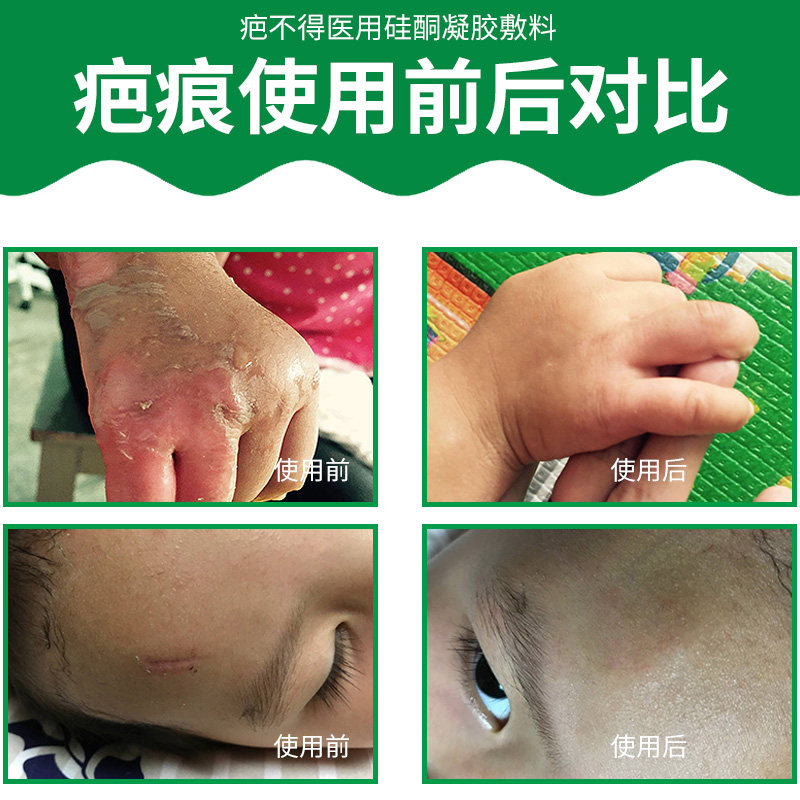 去疤贴烫伤 祛疤膏疤痕修复疤不得克医用硅酮凝胶敷料神器进口正品