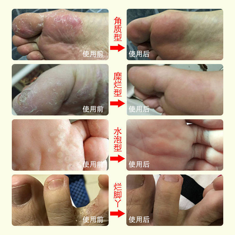 脚气喷剂去根止痒水泡烂脚丫脚痒脚臭脱皮糜烂神器湿疹手癣药膏