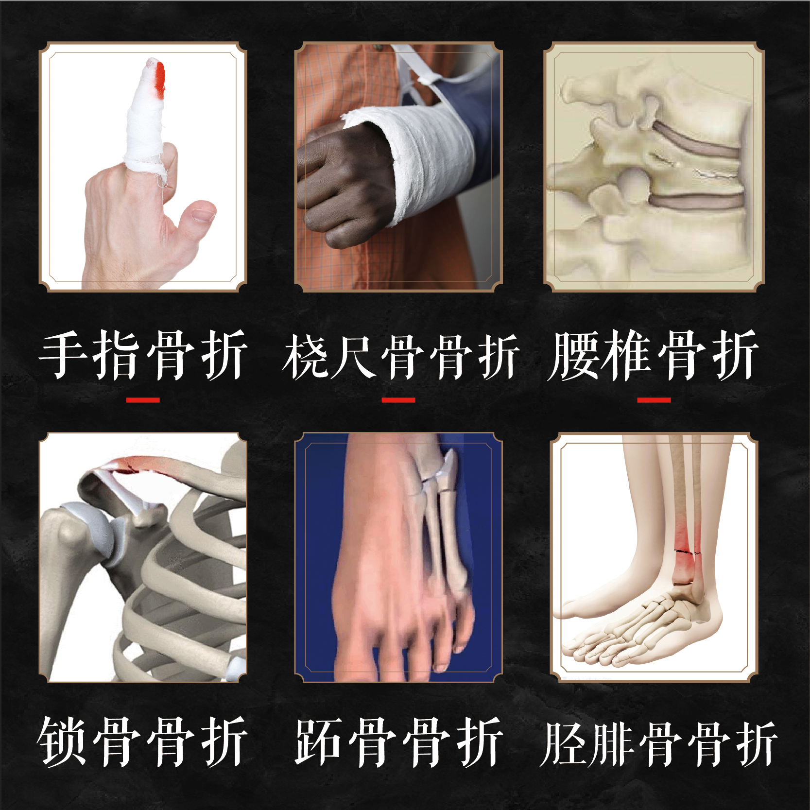 骨折恢复药骨伤骨裂贴膏促生长脚踝手腕续筋接骨膏贴外敷腰椎肋骨