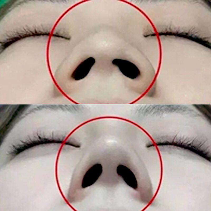 你高鼻梁鼻子增高男女鼻夹缩小鼻翼挺鼻器娇化妆