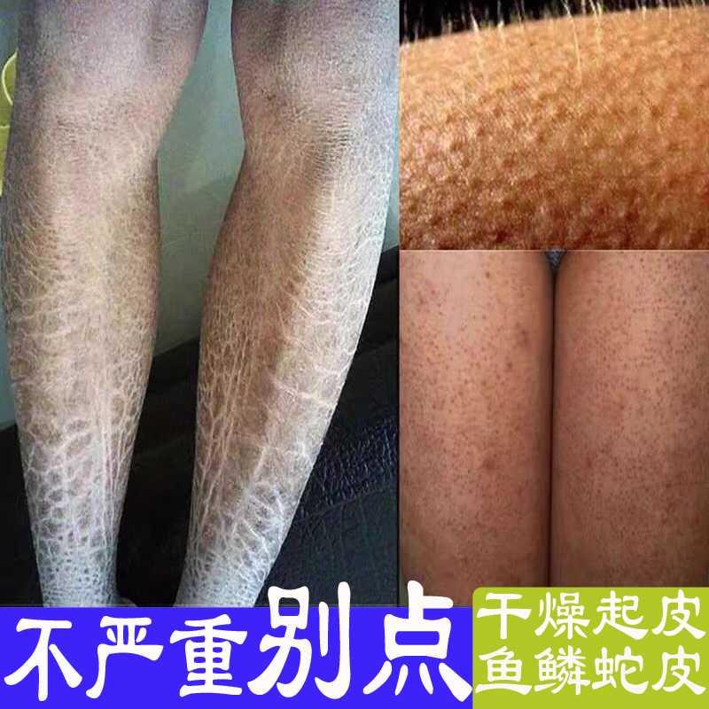 鸡皮鱼鳞身体全身起皮干燥腿部蛇皮皮肤去除其它