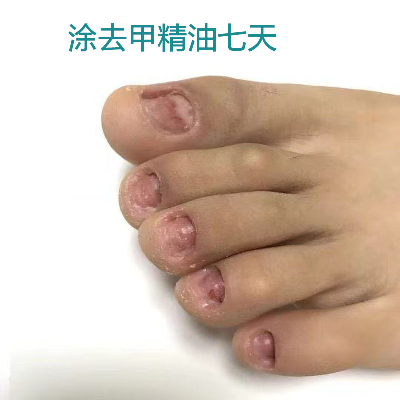 指甲知道脱甲精油去灰甲抑菌液软甲膏脱甲膏指甲彩妆