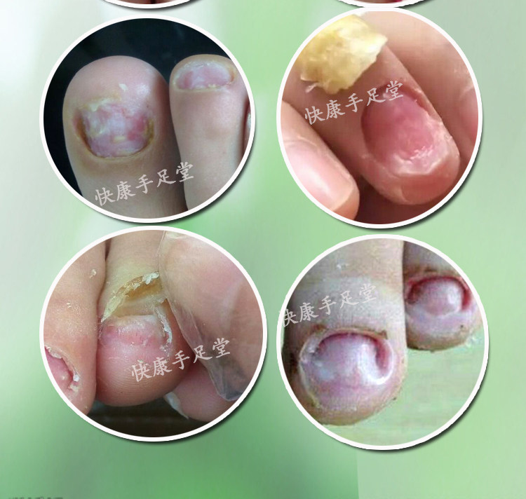 指甲脱甲精油去甲精油指甲增长液灰甲专用长甲软甲膏软化指甲灰甲