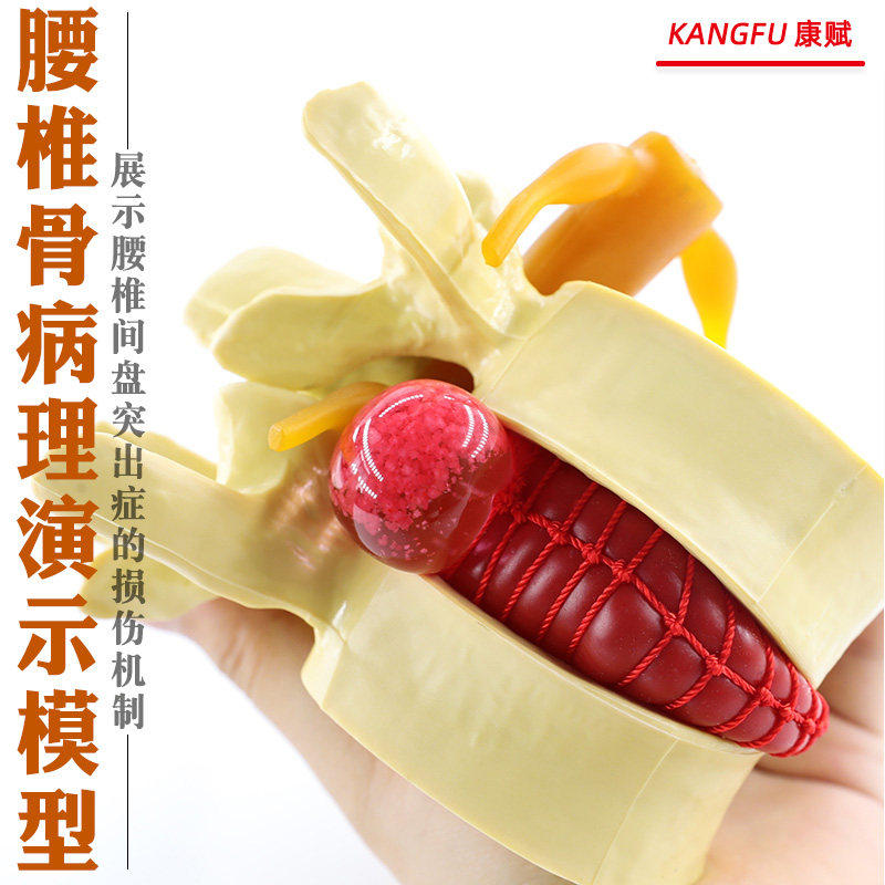演示腰椎放大腰椎间盘受压模型人体脊柱脊椎骨病理其他模型玩具