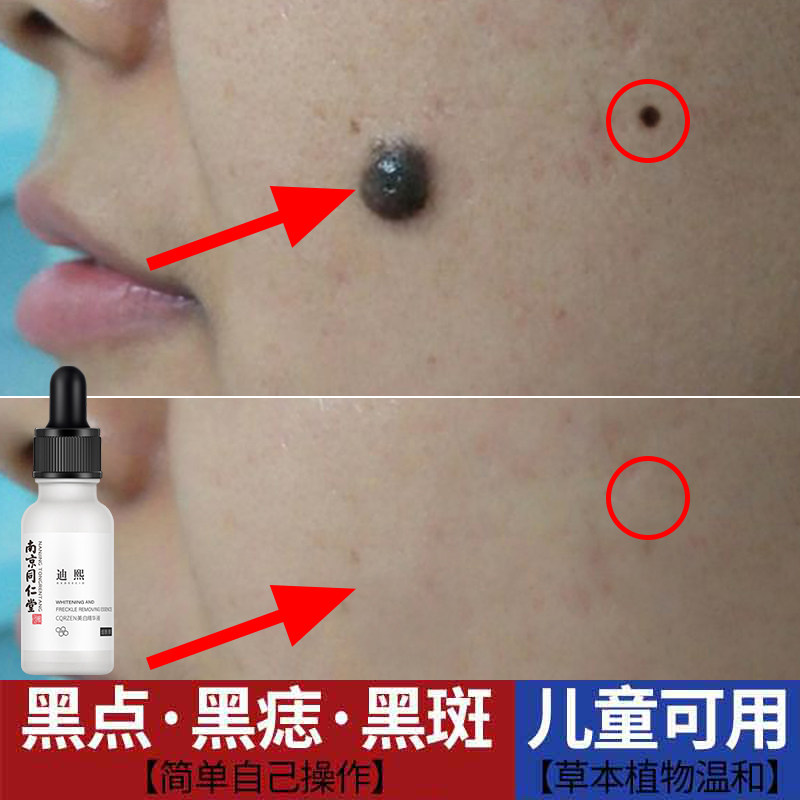升级点痣去痣药水脸部淡斑神器祛痣修复无痕化妆