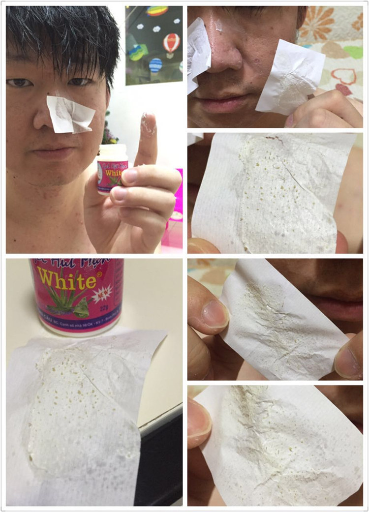 娇娇妈泰国white芦荟胶去黑头水去粉刺去黑头神器鼻贴送收缩水