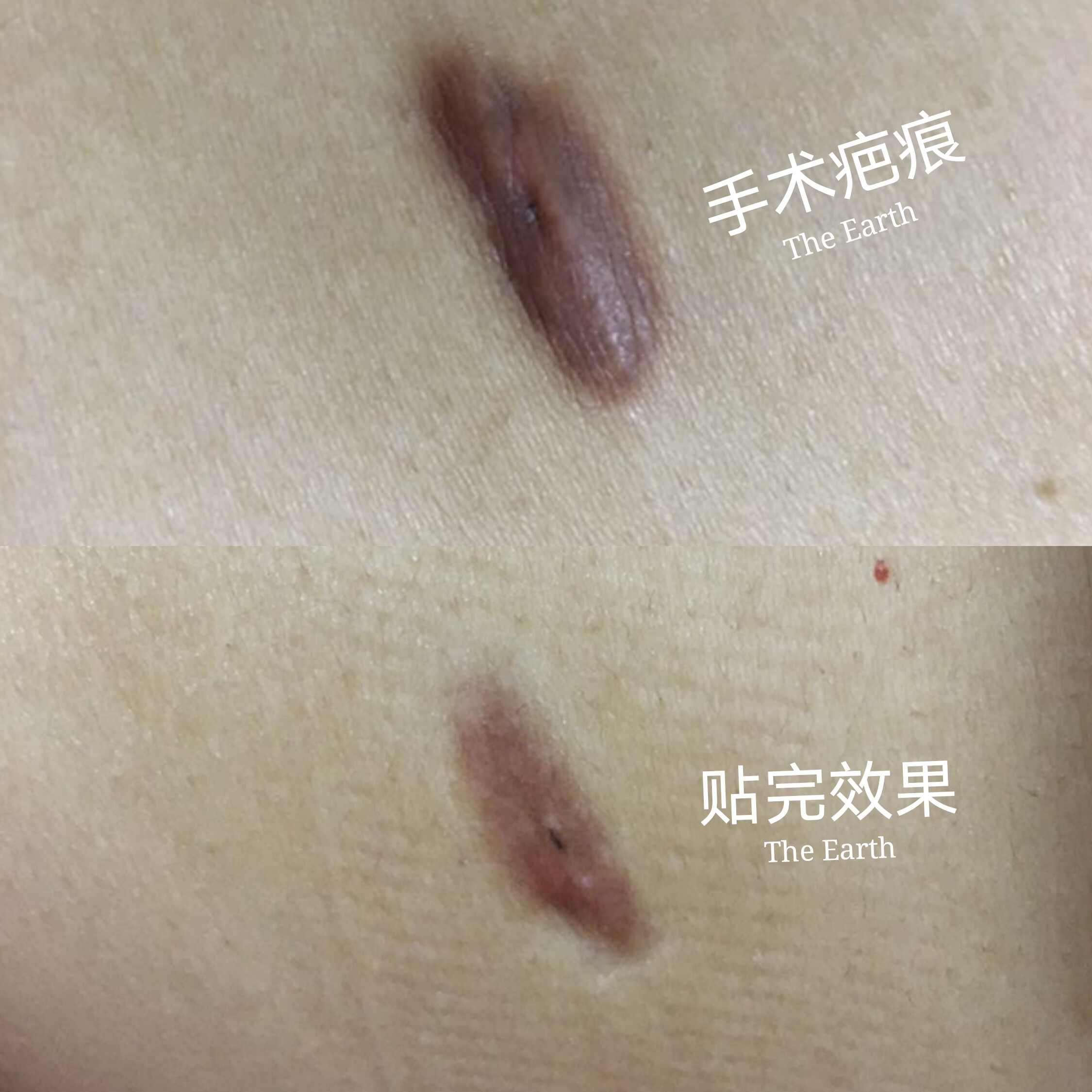 疤痕正品日本小川剖腹产疤痕疙瘩肥厚久光手术增生淡疤护理