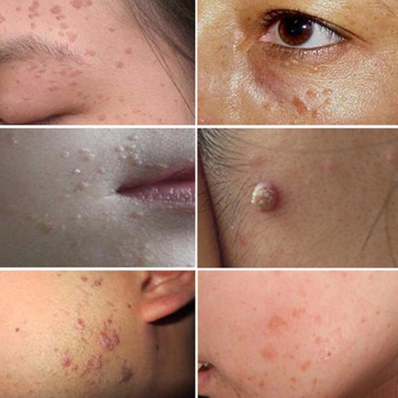 去除瘊子寻常液体腋下丝状赘肉扁平面部脖子皮肤消毒护理(消)