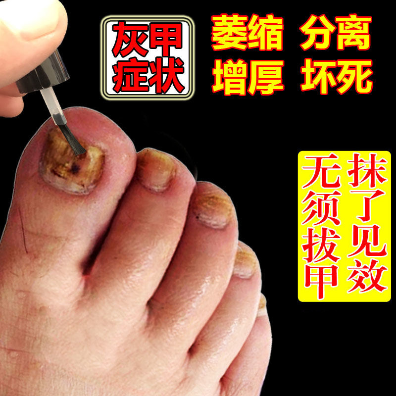 脱甲精油治疗灰指甲专用药水脱甲液灰甲清去除软甲膏无痛增厚抑菌
