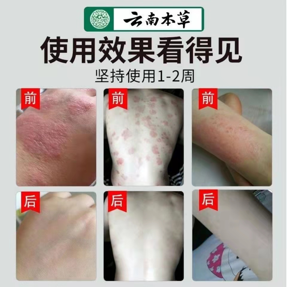 云南本草癣克喷剂湿疹手足癣脚气止痒脚臭脚痒手脚脱皮水泡烂脚丫
