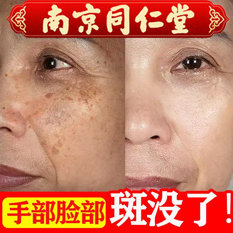 同仁堂祛斑老年斑强力去除黄褐斑手部脸部一抹官方旗舰店乳液