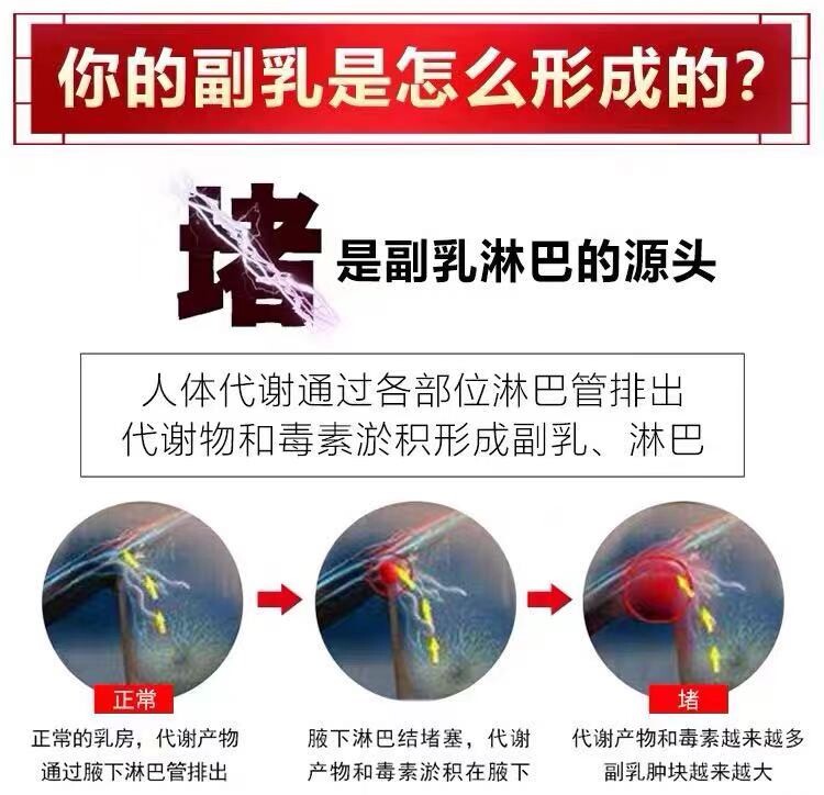 副乳没了淋巴消除腋下结节消散疏通去副神器护膝