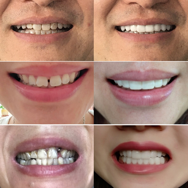 颜美医疗专业设计整齐齐美白牙拍照神器修形牙套其它口腔护理设备