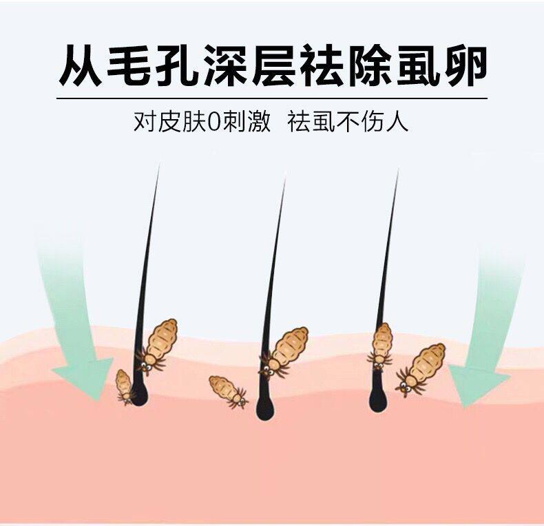 虱子洗发水儿童成人孕妇阴虱小女孩去除灭卵百部杀虫剂卫生农药